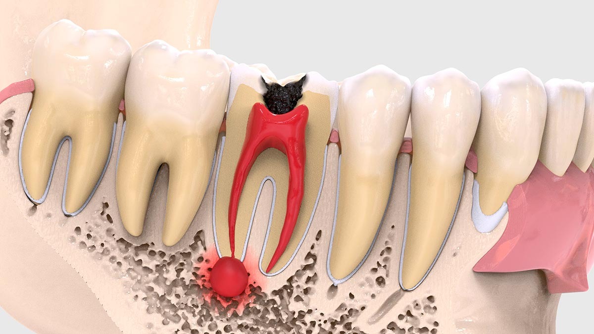 Киста зуба: лечение, симптомы и причины возникновения